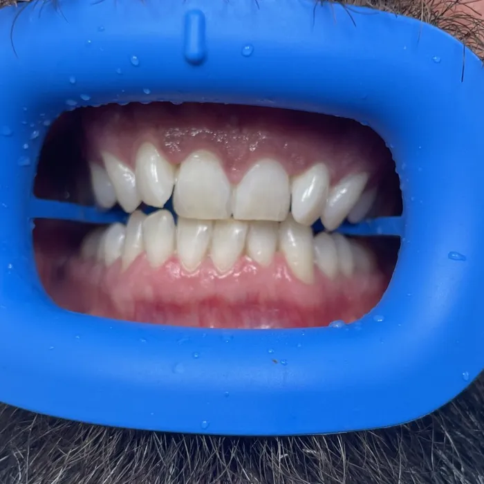 Teeth Whitening — After