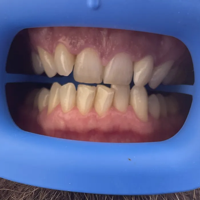 Teeth Whitening — Before