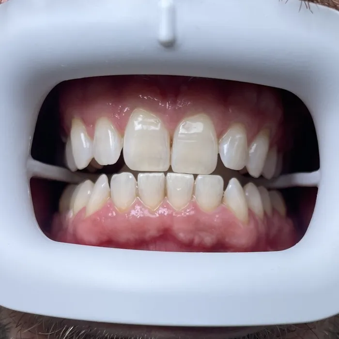 Teeth Whitening — After