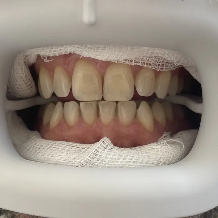 Teeth Whitening — Before