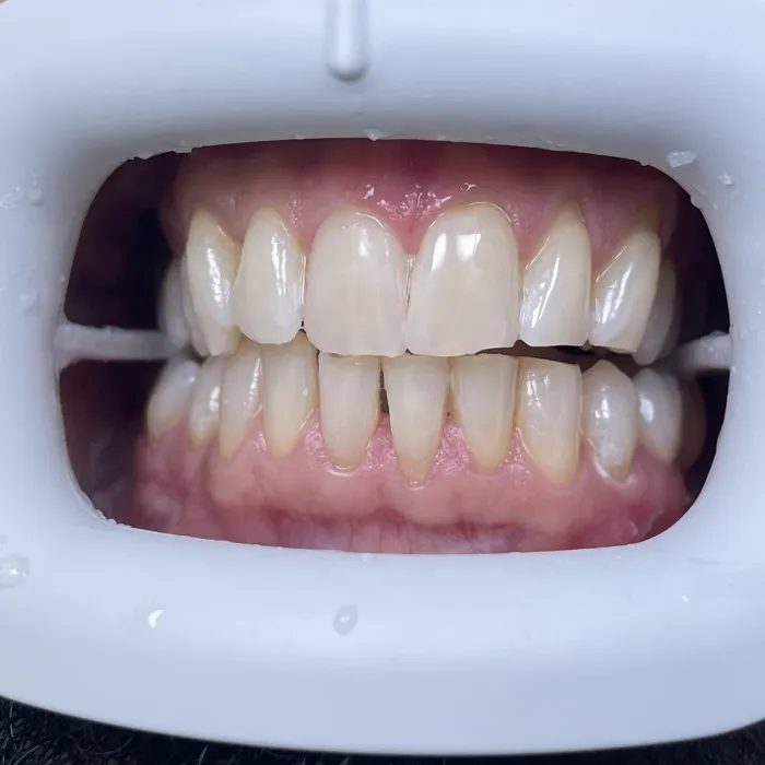 Teeth Whitening — After