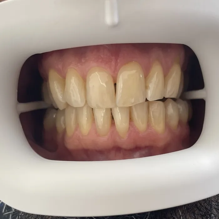 Teeth Whitening — Before