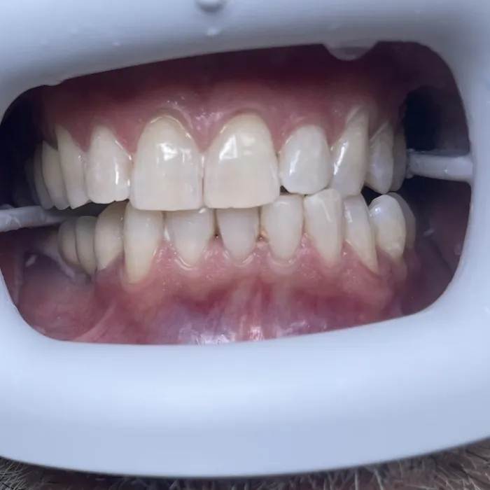 Teeth Whitening — After