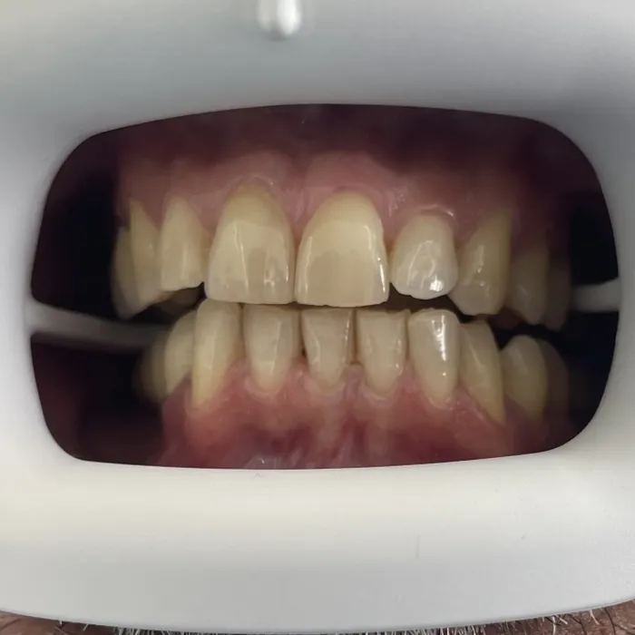 Teeth Whitening — Before