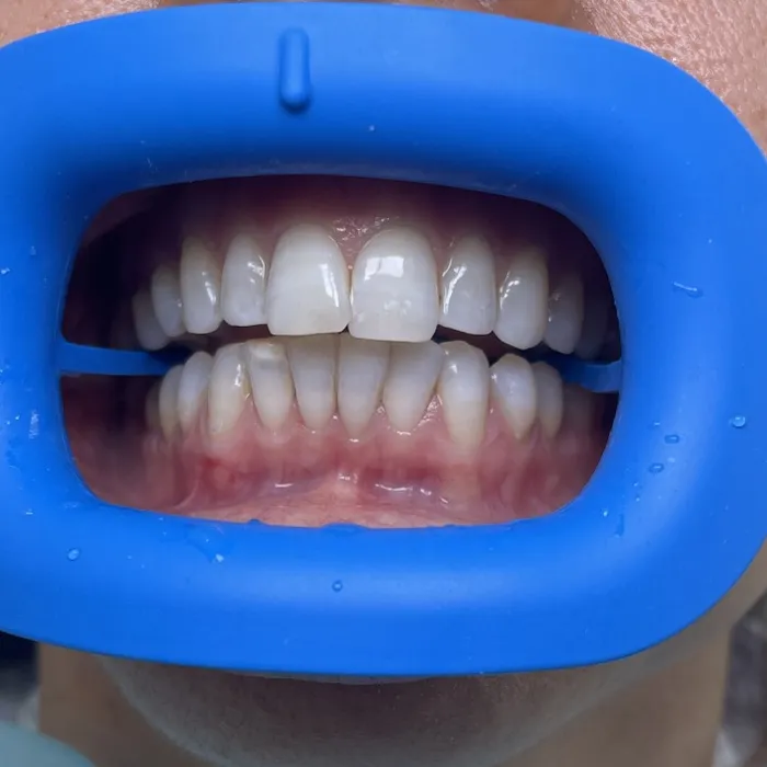 Teeth Whitening — After