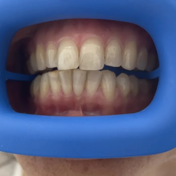 Teeth Whitening — Before